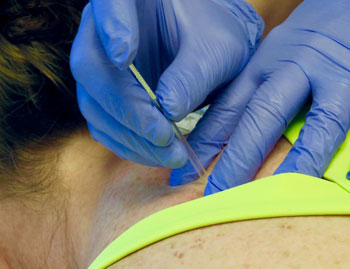 Dry needling at Beebe Healthcare