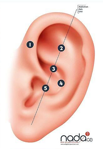 NADA protocol for ear acupuncture