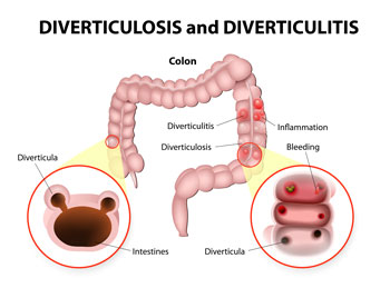 Anatomy of Diverticulitis