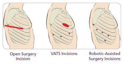 Lung cancer surgery options are available. Here is an illustration showing the different types of procedures and associated incision locations.