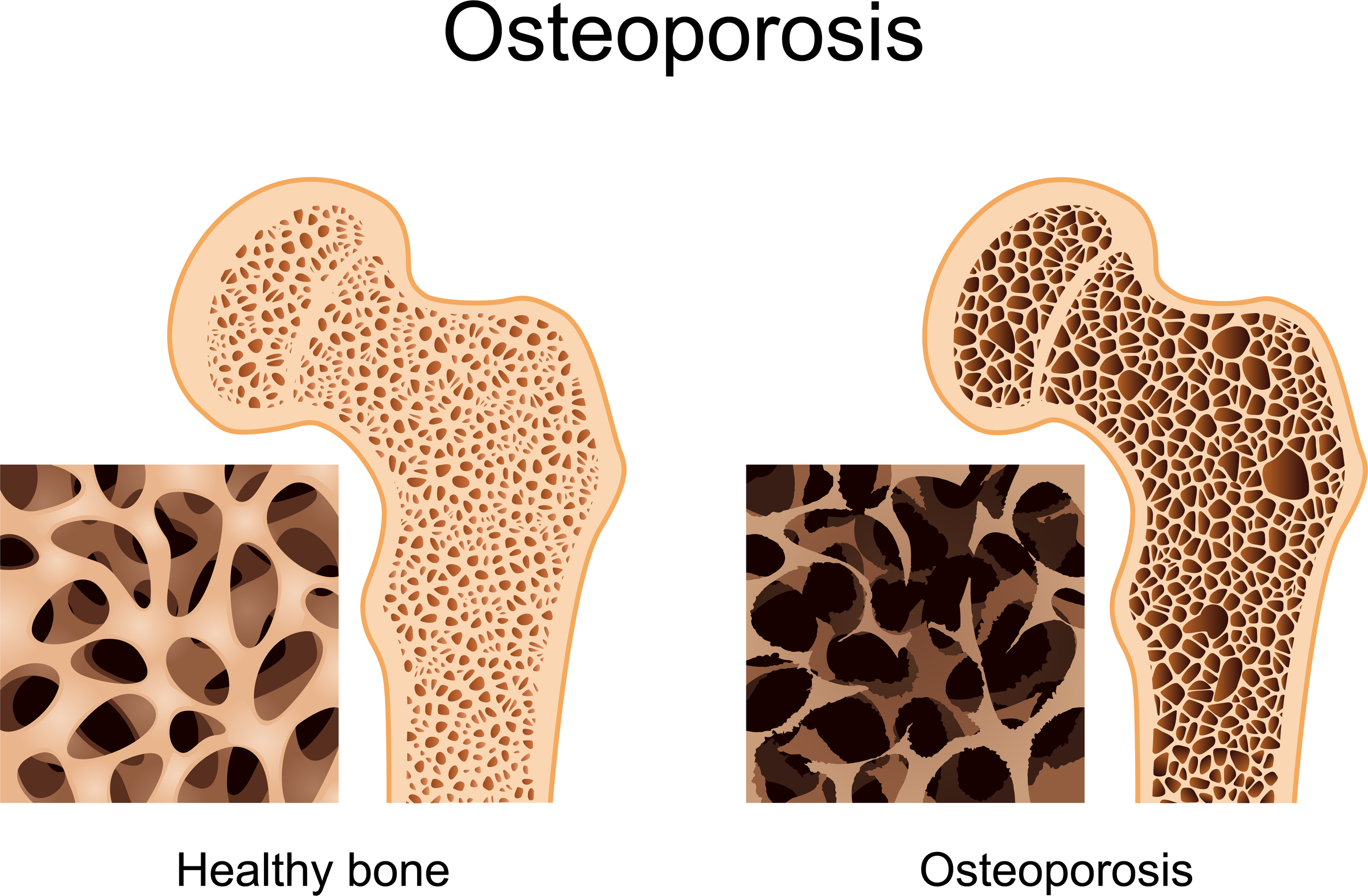 What is the Connection Between Breast Cancer and Bone Health | Beebe  Healthcare