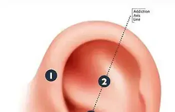 Ear Seeds image_NADA protocol