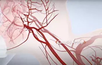 Carotid artery disease TCAR image