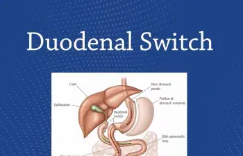 duodenal switch