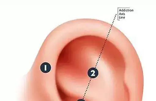 Ear Seeds image_NADA protocol