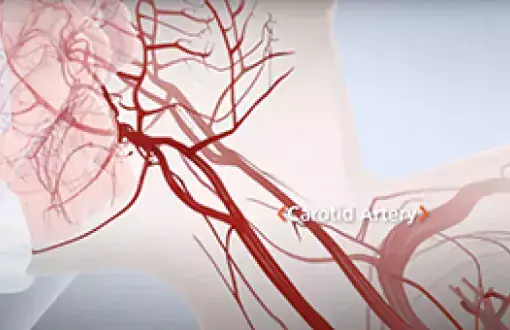 Carotid artery disease TCAR image