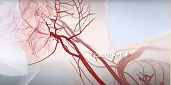 Carotid artery disease TCAR image