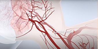 Carotid artery disease TCAR image
