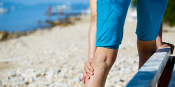 Woman with varicose veins - could it signal a deeper health concern? Woman with varicose veins - could it signal a deeper health concern?