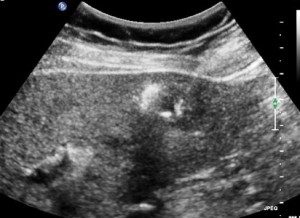Liver cancer Ablation_B_second ultrasoundrevised